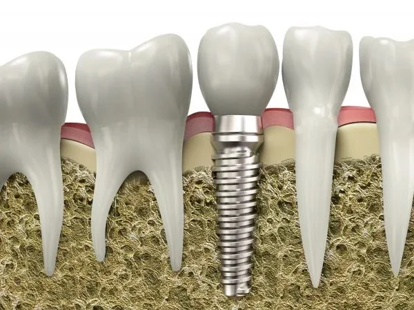 Dental implant screw and crown anchored in jawbone between natural teeth.